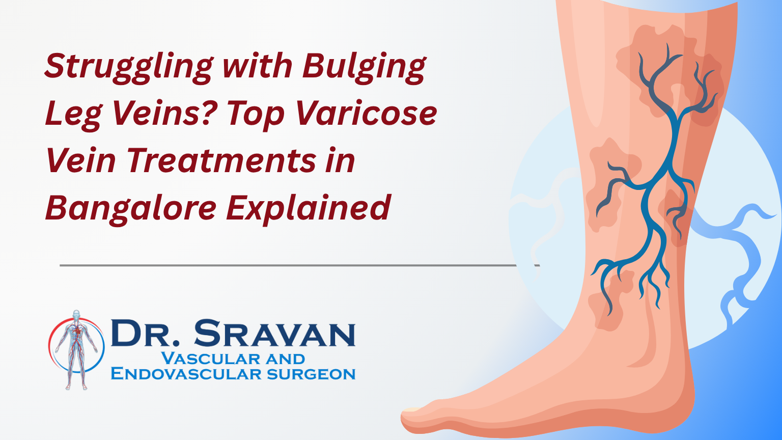 Struggling with Bulging Leg Veins? Top Varicose Vein Treatments in Bangalore Explained