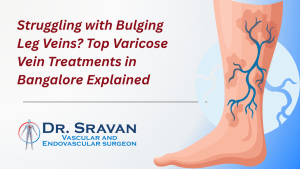 illustration of varicose vein treatment in Bangalore by vascular surgeon
