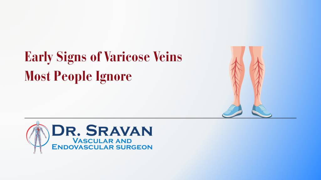 Early Signs of Varicose Veins Most People Ignore
