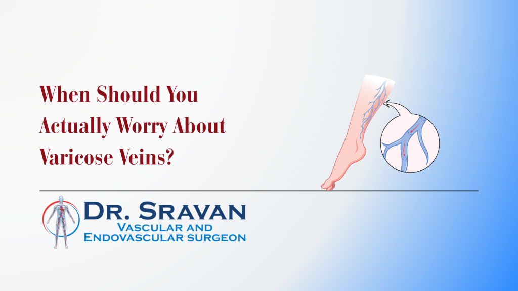 When Should You Actually Worry About Varicose Veins?