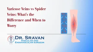 Varicose Veins vs Spider Veins: What’s the Difference and When to Worry