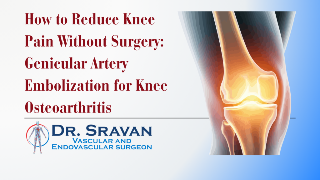 How to Reduce Knee Pain Without Surgery: Genicular Artery Embolization for Knee Osteoarthritis