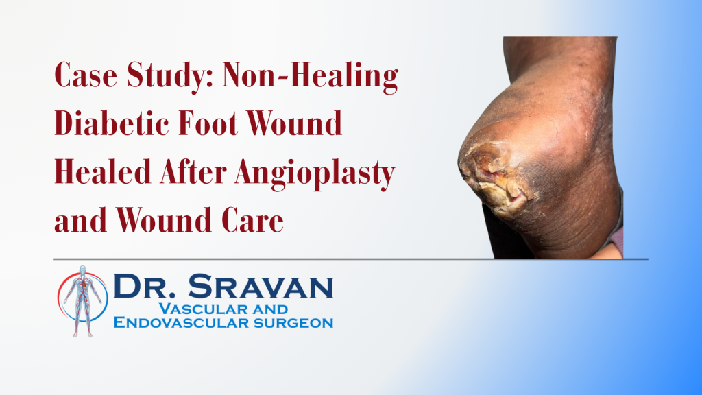 Case Study: Non-Healing Diabetic Foot Wound Healed After Angioplasty and Wound Care