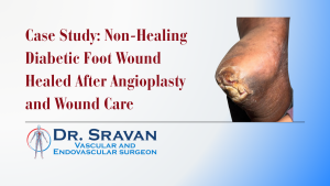 Case Study: Non-Healing Diabetic Foot Wound Healed After Angioplasty and Wound Care