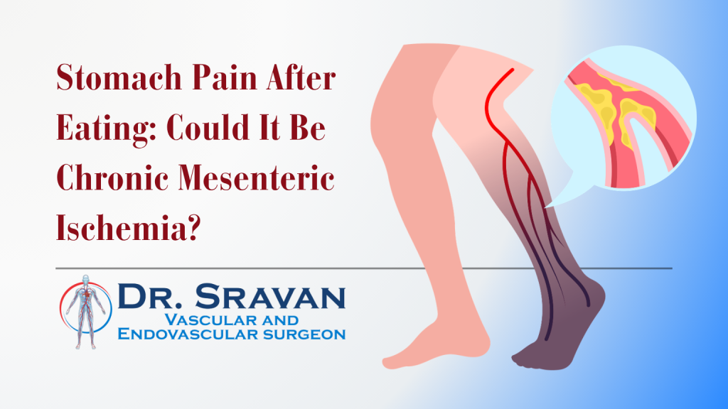 Stomach Pain After Eating: Could It Be Chronic Mesenteric Ischemia?