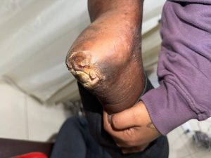 Non-healing diabetic heel wound before angioplasty for peripheral artery disease