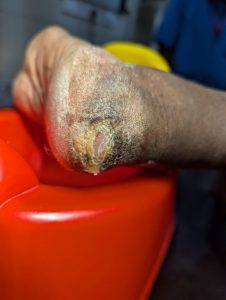 Healed diabetic heel wound 3 months after angioplasty and wound care