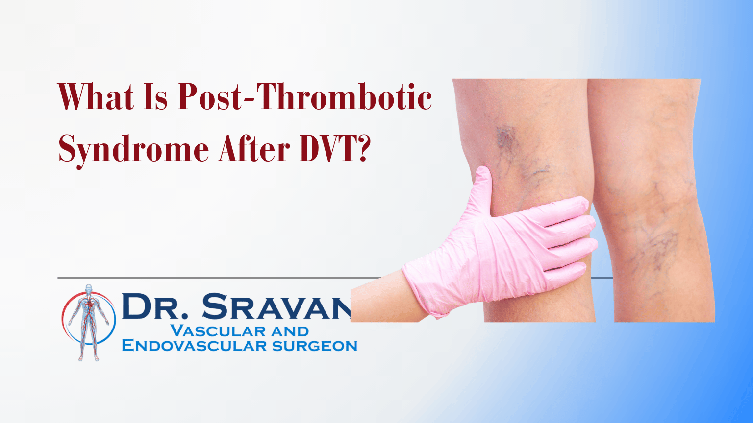 What Is Post-Thrombotic Syndrome After DVT?