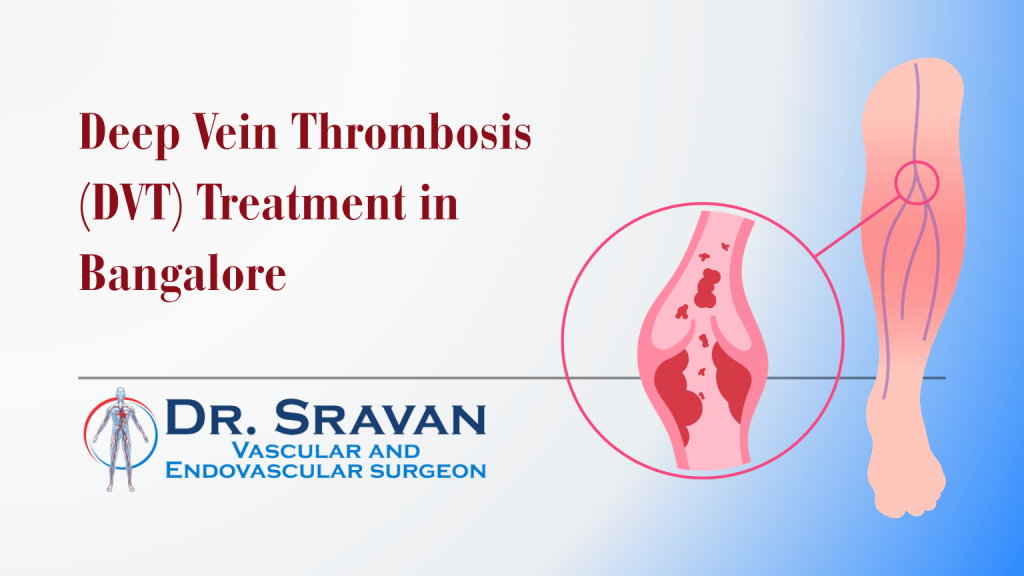 Deep Vein Thrombosis (DVT) Treatment in Bangalore