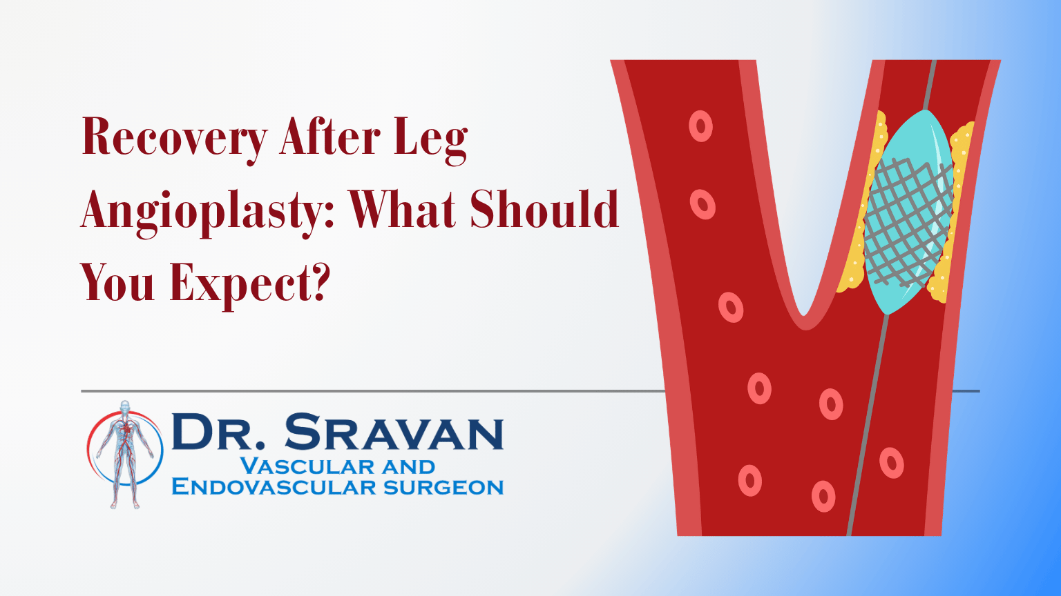 Recovery After Leg Angioplasty: What Should You Expect?