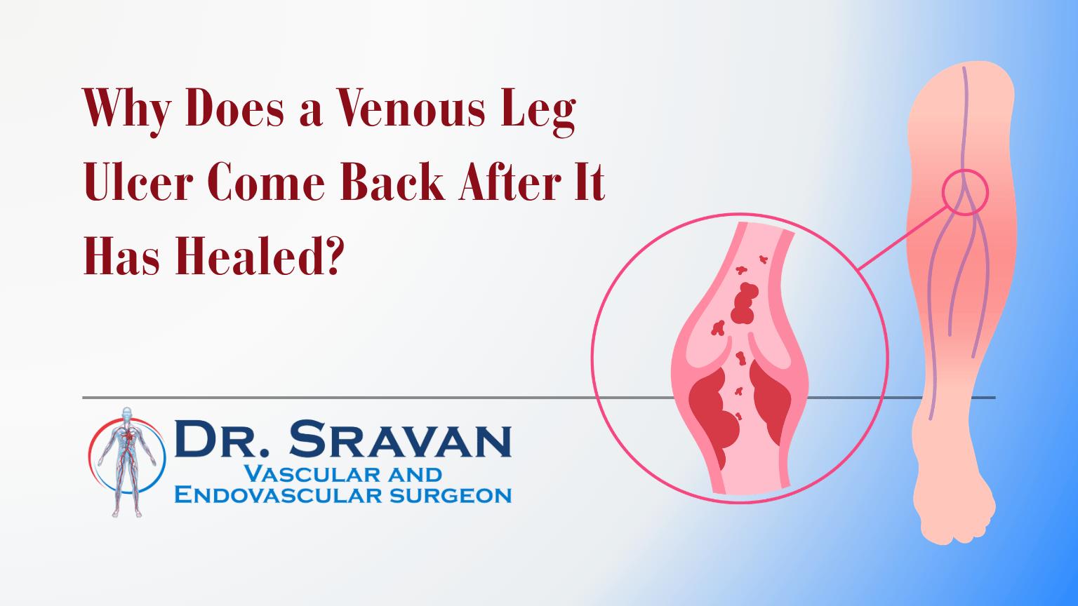 Why Does a Venous Leg Ulcer Come Back After It Has Healed?