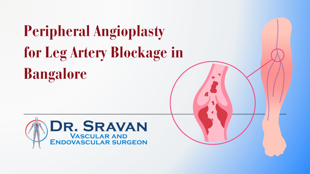 Peripheral Angioplasty for Leg Artery Blockage in Bangalore | Peripheral Angioplasty for Leg Artery Blockage in Bangalore