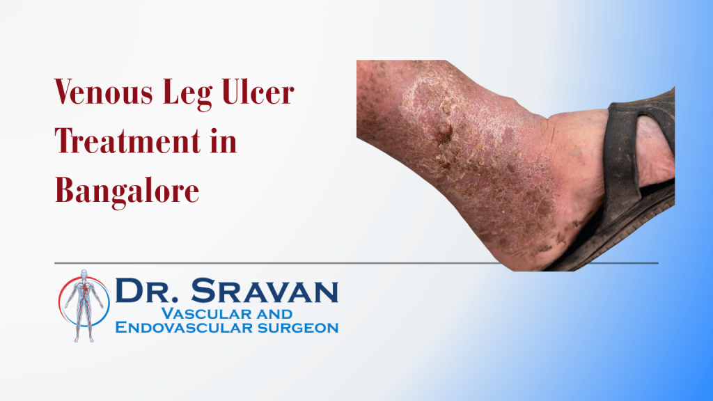Venous Leg Ulcer Treatment in Bangalore | Venous Leg Ulcer Treatment in Bangalore