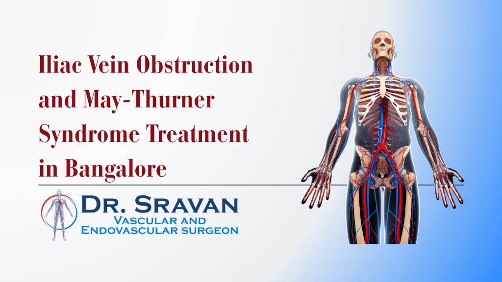 Iliac Vein Obstruction and May-Thurner Syndrome Treatment in Bangalore | Iliac Vein Obstruction and May-Thurner Syndrome Treatment in Bangalore