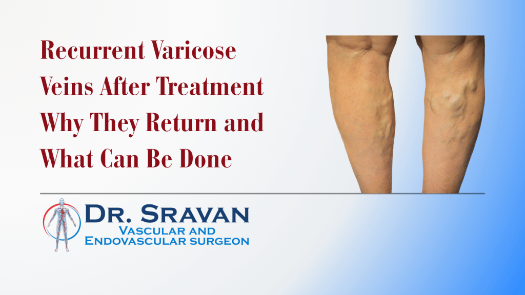Recurrent Varicose Veins After Treatment in Bangalore: Why They Return and What Can Be Done | Recurrent Varicose Veins After Treatment in Bangalore: Why They Return and What Can Be Done